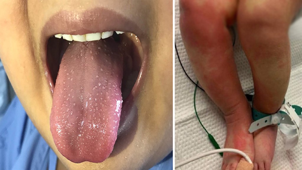 بعد بريطانيا وإيطاليا مرض كاواساكي النادر يصيب 15 طفلاً في نيويورك وأطباء يخشون من ارتباطه بفيروس كورونا!