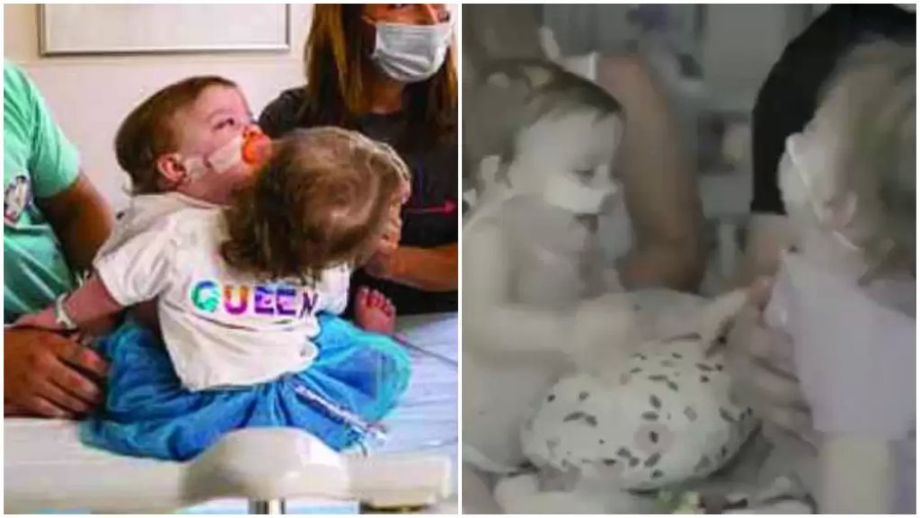 بالفيديو/ فصل توأم فتاتين ملتصقتين بكبد واحدة بعملية استغرقت 11 ساعة أكثر من 24 طبيب وممرضة!