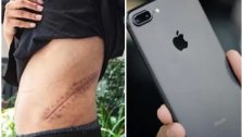 باع كليته منذ سنوات لشراء جهاز iPhone.. وأصبح الآن طريح الفراش مدى الحياة!