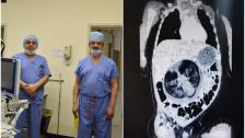 بالصور/ في عملية جراحية نادرة.. أطباء عمانيون ينجحون باستئصال &laquo;جنين من داخل جنين&raquo; !