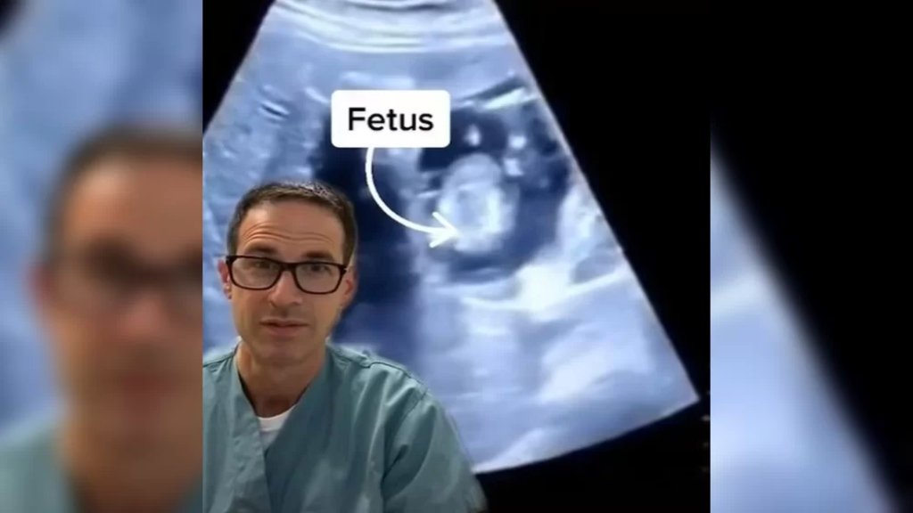 بالفيديو/ طبيب يكشف عن حالة نادرة للغاية لحمل خارج الرحم: نمو جنين داخل كبد والدته!