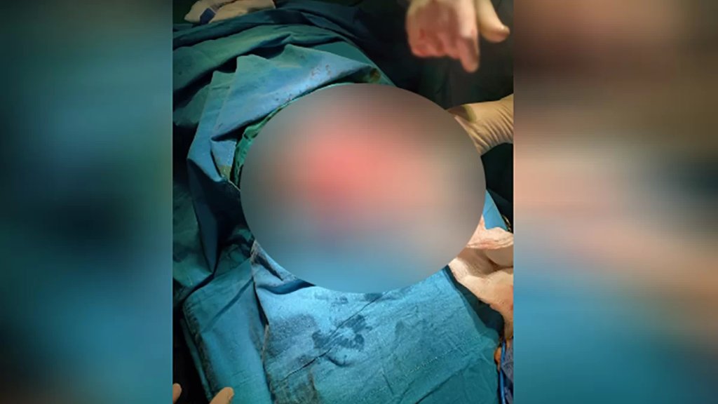 ناجمة عن مثابرة ابنة الـ 19عاماً على أكل الشعر منذ عدة سنوات.. عملية غريبة من نوعها في مستشفى بعلبك حيث تم استئصال كتلة شعر أقفلت معدة مريضة بالكامل!