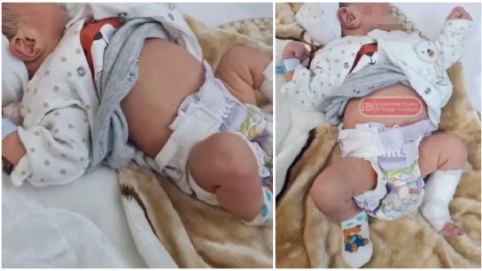 حالة نادرة جدًا.. ولادة طفل يحمل توأمه داخل بطنه في تونس!