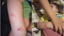 بالصور/ ابن السنة و8 أشهر يتعرض للعضّ من طفل آخر في حضانة بجبيل!