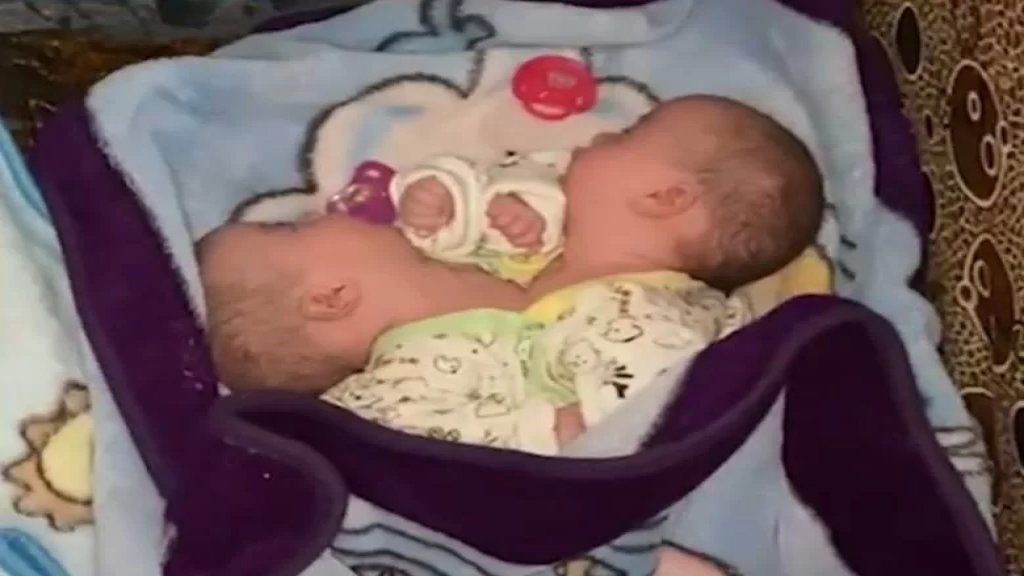 بالفيديو/ ولادة توأم سيامي في مستشفى رفيق الحريري في بيروت: حالتهما نادرة