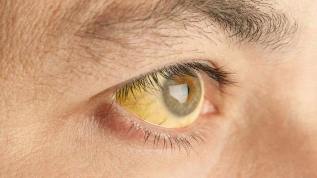 "اليرقان" ينتشر في بلدة كامد اللوز.. ومحافظ البقاع يؤكد اتخاذ اجراءات لمنع تفشيه!