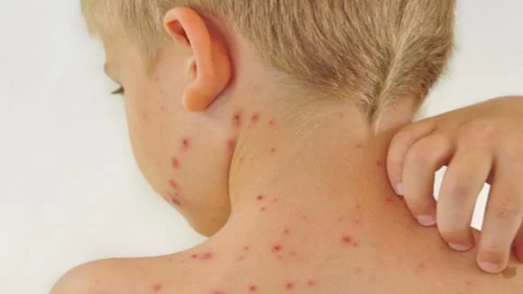 لا جائحة جرب في لبنان!