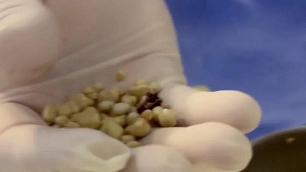 بسبب المشروبات الغازية.. طبيب يستخرج 30 حصوة من كلية رجل!